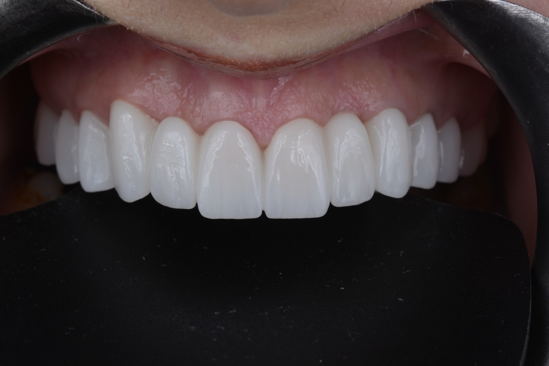 Biomimetic Zirconia Reconstruction - AFTER // CLINICAL SMILE