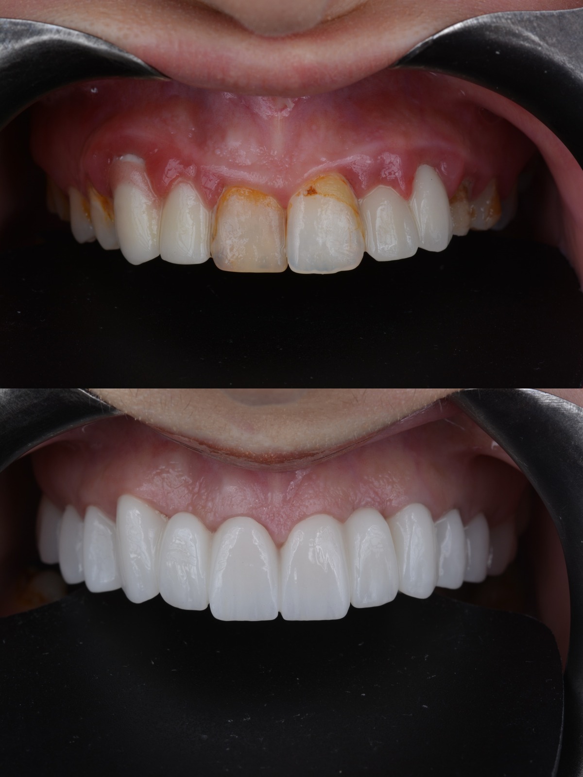 Gingival Aesthetics & Layered Zirconia Makeover - Before and After Smile Transformation
