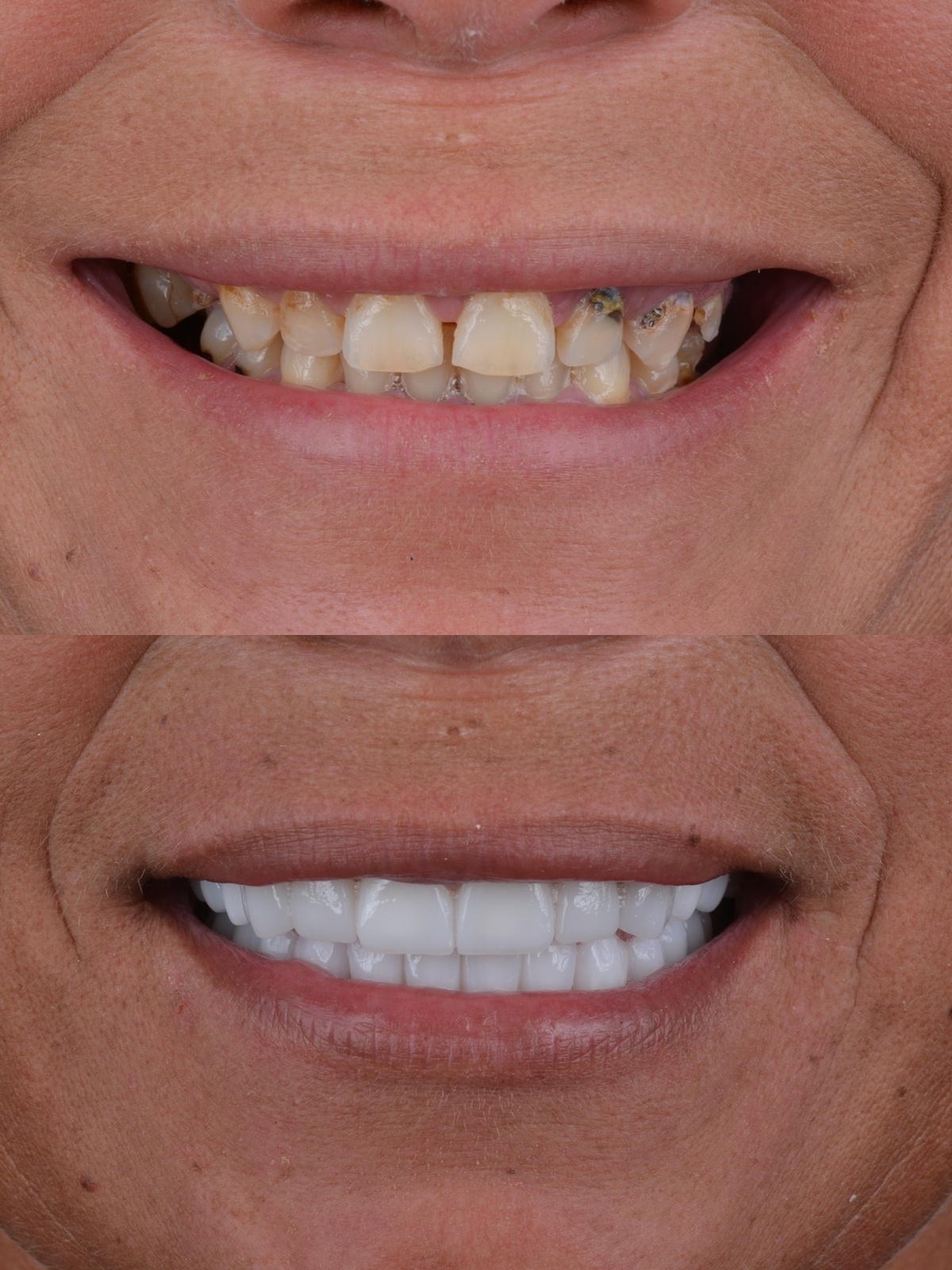 Hollywood Smile Arc & 24-Unit Dual Arch Zirconia - Before and After Smile Transformation