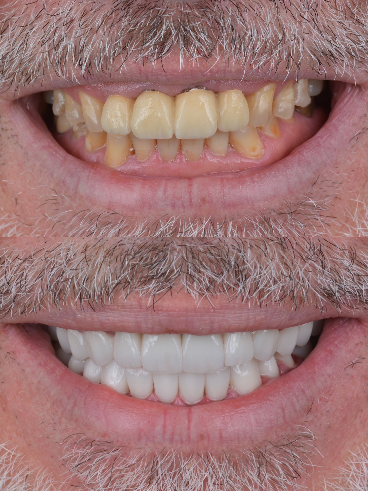 Severe Attrition & 25-Unit Zirconia Reconstruction - Before and After Smile Transformation