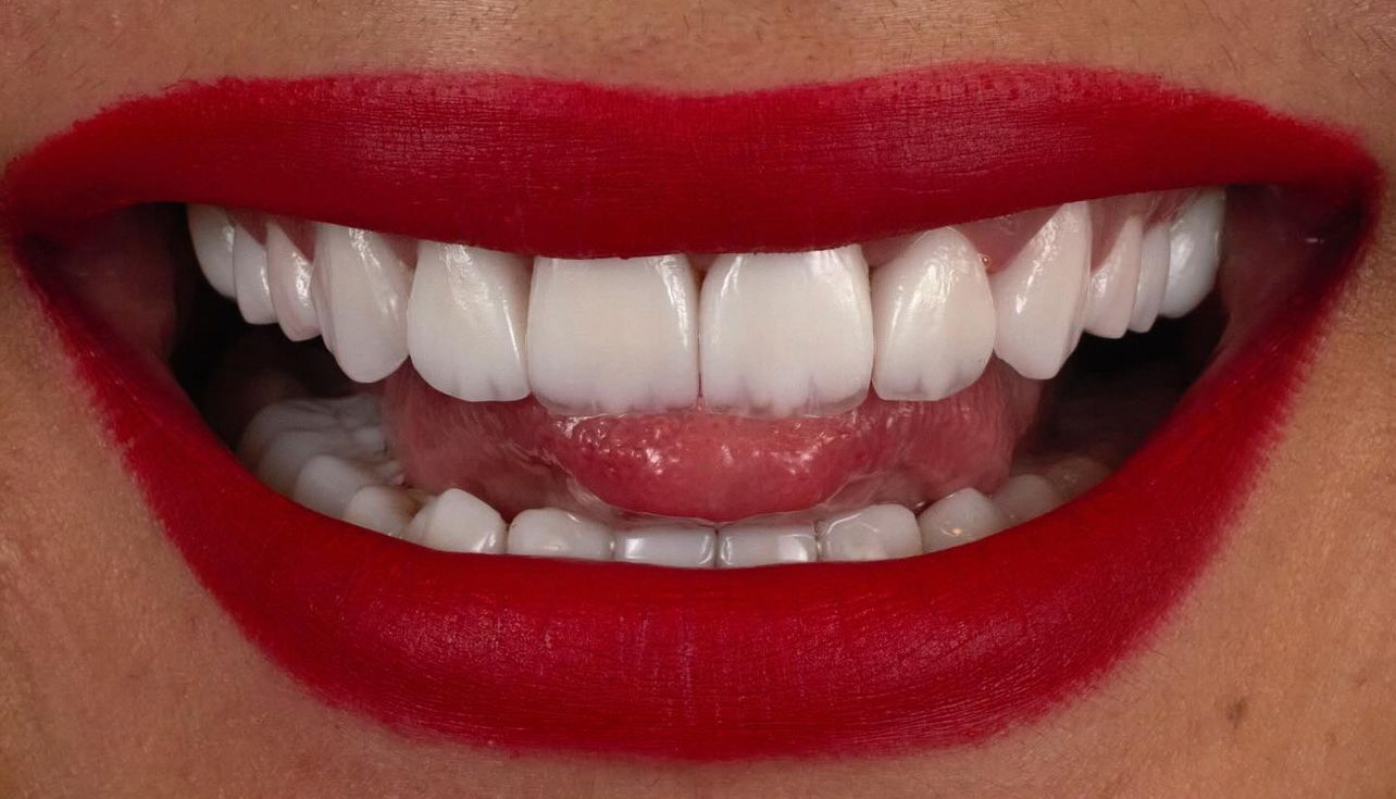 Minimal-Prep E-Max Porcelain Veneers